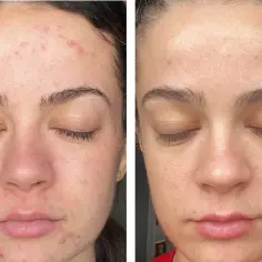 Co daje peeling enzymatyczny? Korzyści, efekty i dla kogo jest najlepszy