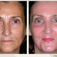 Peeling fenolowy ile się goi? Poznaj czas regeneracji skóry